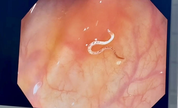 Hình ảnh con giun trong đại tràng của người bệnh