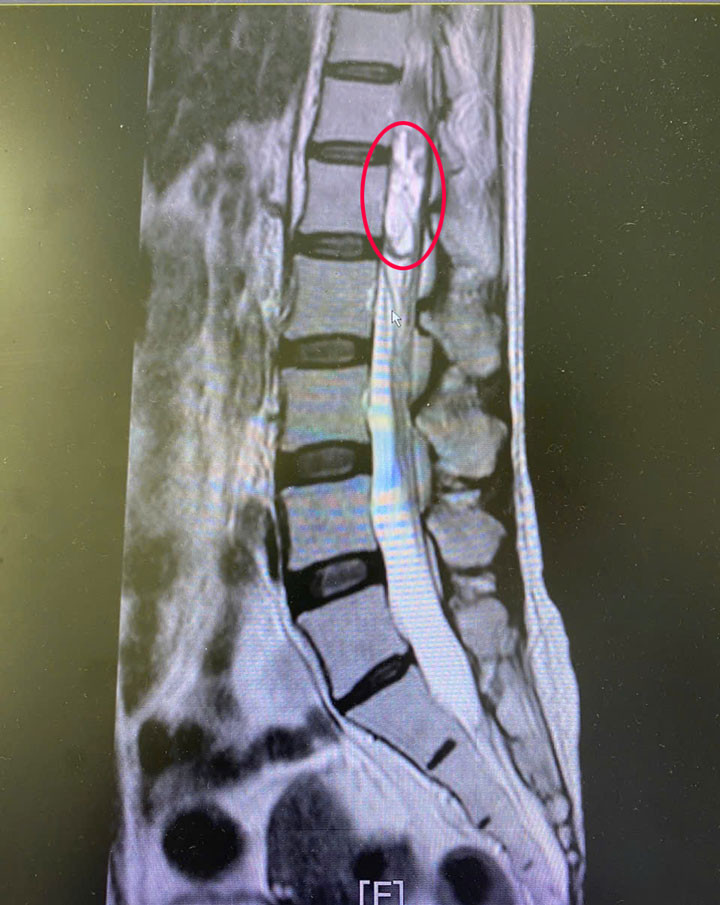 Khối u tủy sống của người bệnh (vùng khoanh tròn màu đỏ)