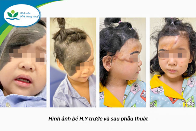 U hắc tố khổng lồ – Căn bệnh hiếm gặp, cần phẫu thuật nhiều lần và kết hợp nhiều kỹ thuật để điều trị