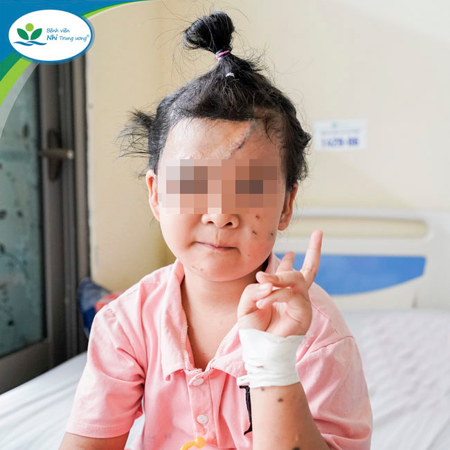 Hiện tại, phần u hắc tố trên mặt bé H.Y đã được cắt bỏ, vùng mắt và cung mày 2 bên cân đối, trẻ tự tin hơn với diện mạo mới của mình