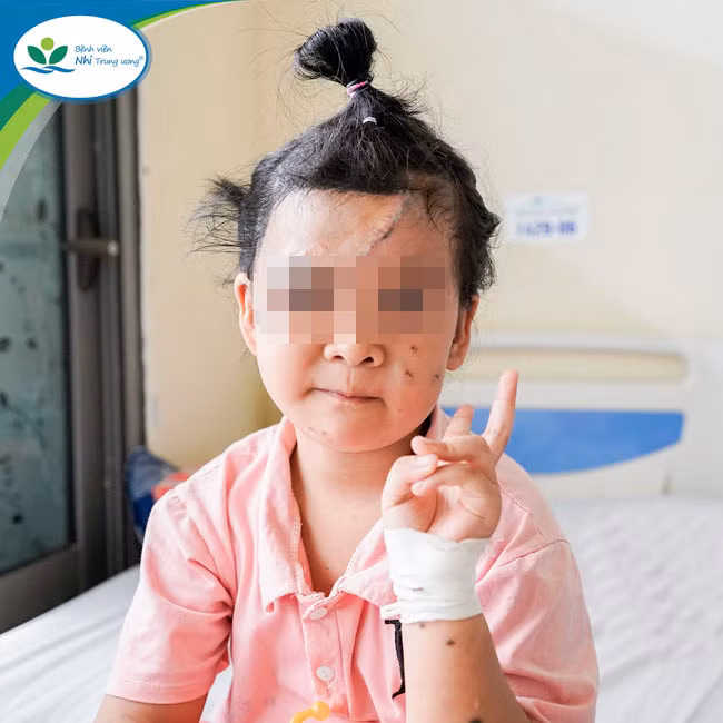 Hiện tại, phần u hắc tố trên mặt bé H.Y đã được cắt bỏ, vùng mắt và cung mày 2 bên cân đối, trẻ tự tin hơn với diện mạo mới của mình