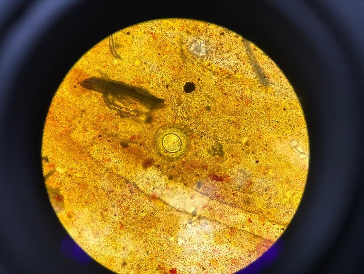 Trứng sán dây chuột trong mẫu phẩm của một bệnh nhân khi soi qua kính hiển vi. Ảnh BVCC