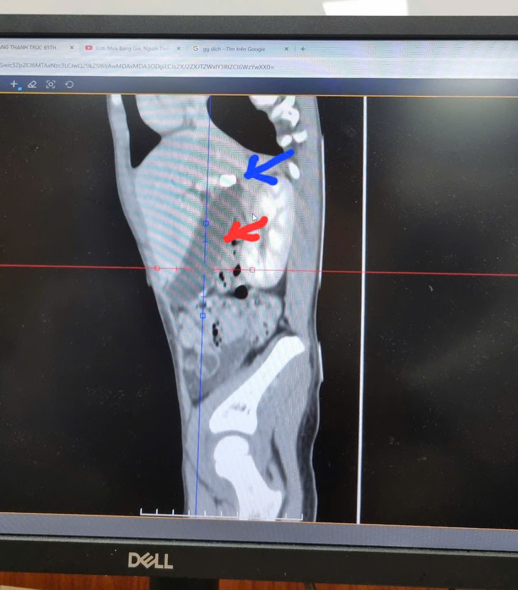 Sỏi túi mật trên màn hình - Ảnh BVCC