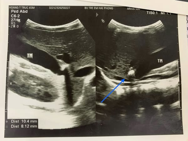 Hình ảnh sỏi túi mật trên siêu âm - Ảnh BVCC