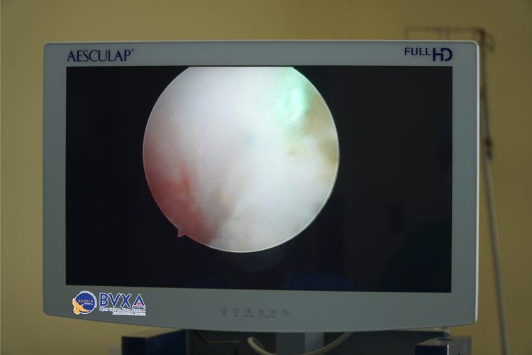 Hình ảnh nội soi bóc tách khối phì đại bằng lazer - Ảnh BVCC