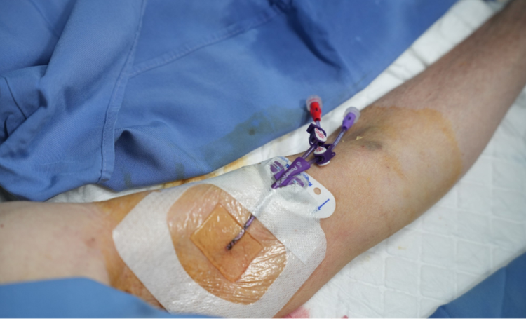 Khoa Hồi sức tích cực Ung bướu, Bệnh viện Bãi Cháy triển khai kỹ thuật đặt catheter tĩnh mạch trung tâm qua đường ngoại vi (PICC line) mang đến nhiều ưu điểm vượt trội như hiện đại, an toàn, độ bền cao, ít biến chứng - Ảnh BVCC