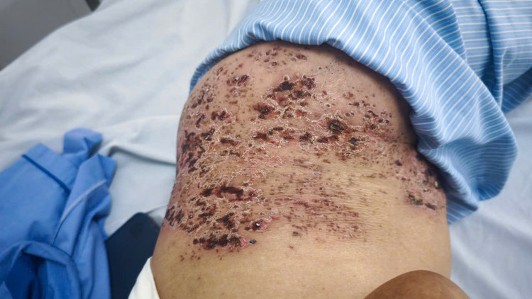 Tổn thương da nặng do tự điều trị zona thần kinh - Ảnh BVCC