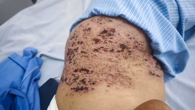 Tổn thương da nặng do tự điều trị zona thần kinh - Ảnh BVCC