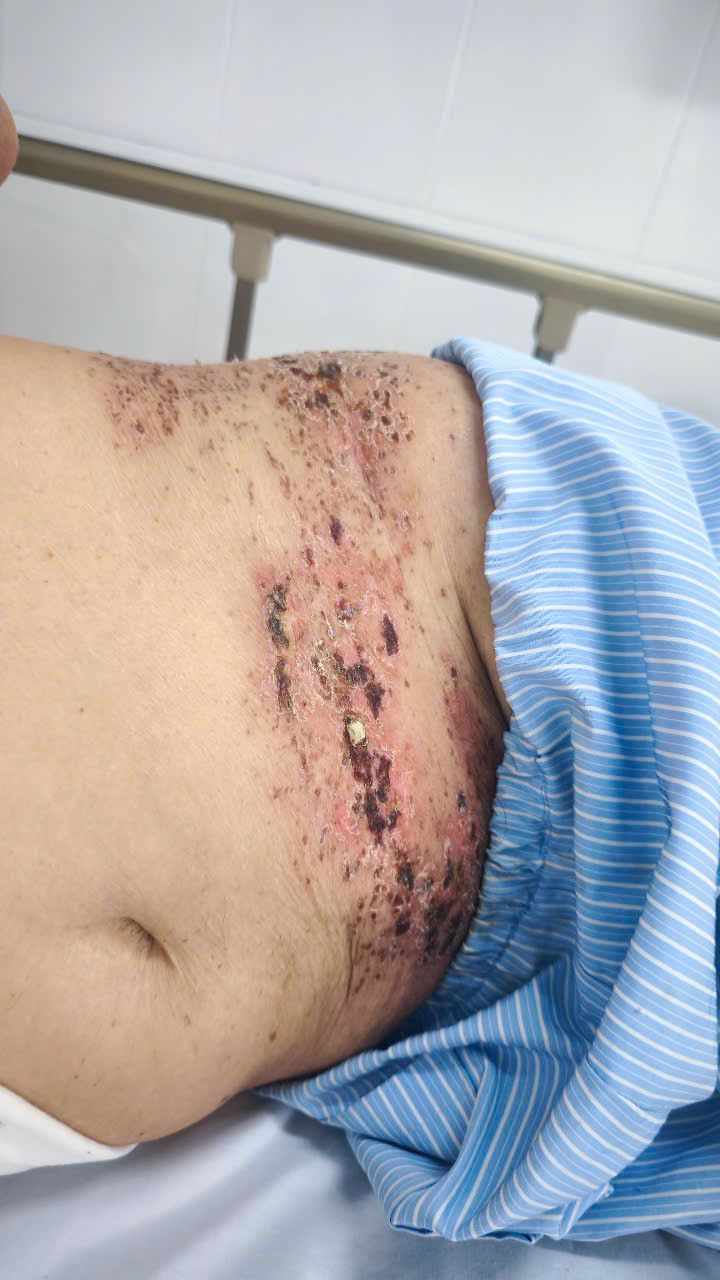 Mắc zona thần kinh kèm đau dây thần kinh sau zona - Ảnh BVCC