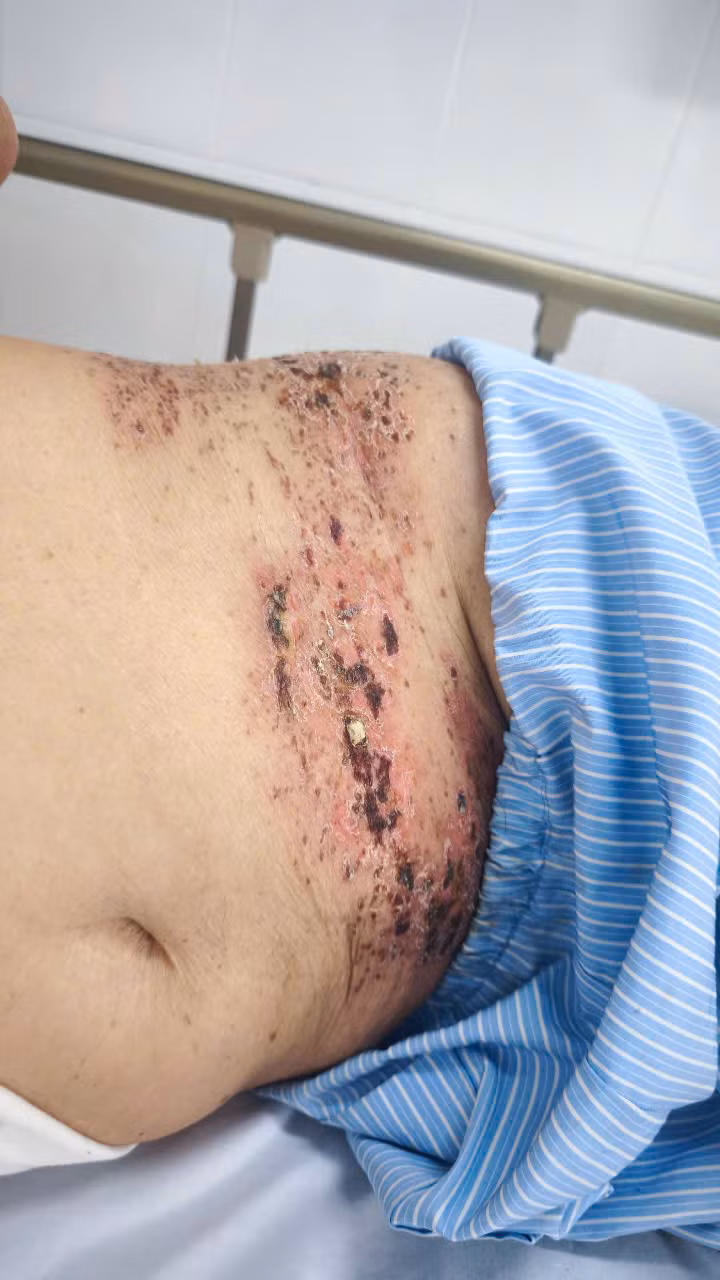 Mắc zona thần kinh kèm đau dây thần kinh sau zona - Ảnh BVCC