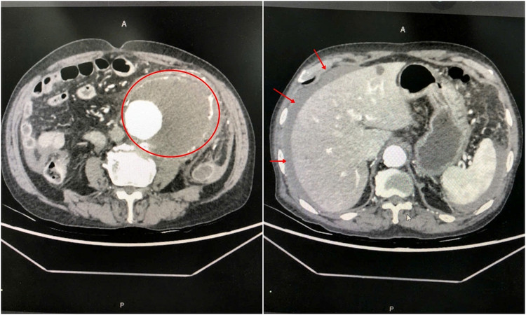 Hình ảnh chụp cắt lớp khối phình động mạch chủ bụng và dịch máu tràn ổ bụng do vỡ túi phình - Ảnh BVCC