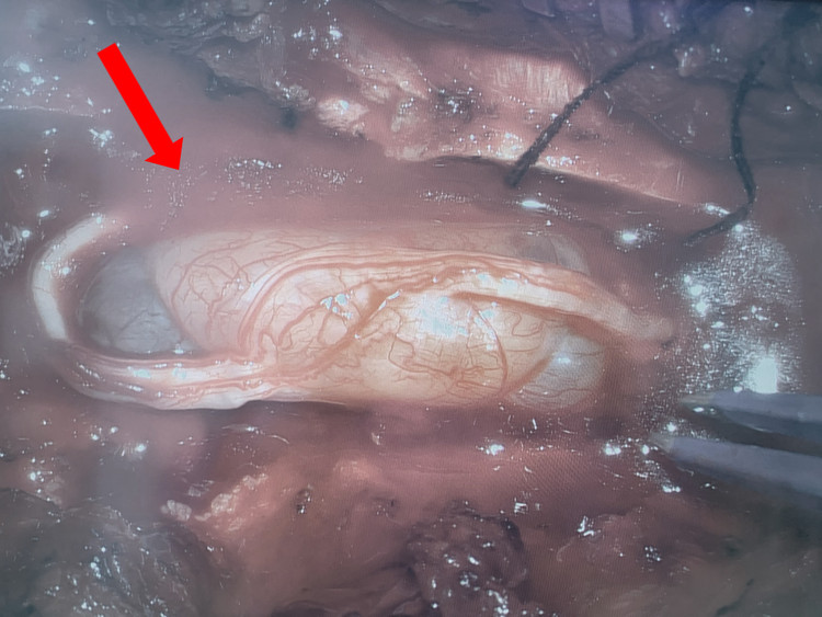 U trong tủy sống - Ảnh BVCC