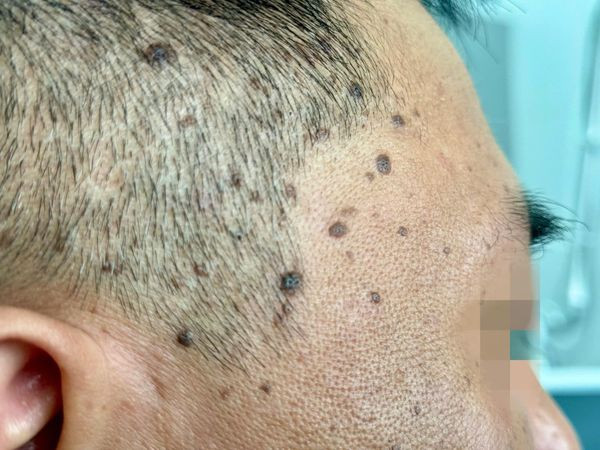 Laser CO2 điều trị dày sừng da dầu, các nốt nâu, đen trên mặt ảnh 1