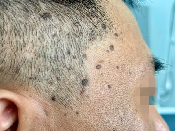 Laser CO2 điều trị dày sừng da dầu, các nốt nâu, đen trên mặt ảnh 1