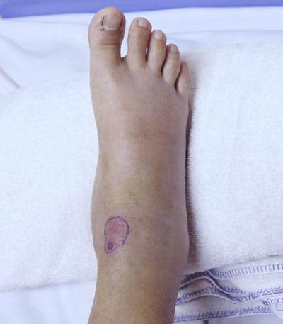 Vùng cổ chân của người bệnh - Ảnh BVCC Vùng cổ chân của người bệnh - Ảnh BVCC