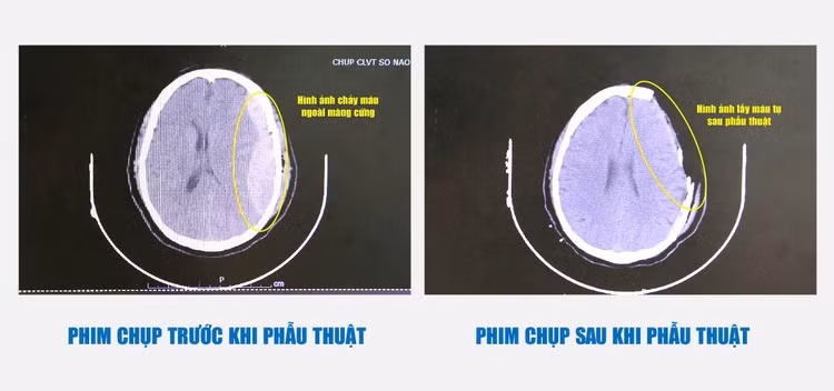 Hình ảnh phim chụp trước và sau khi phẫu thuật lấy máu tụ -- Ảnh BVCC