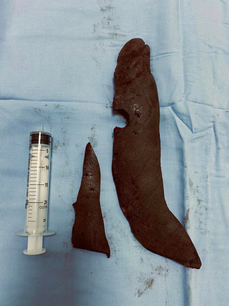 2 khối nơ vi được cắt bỏ