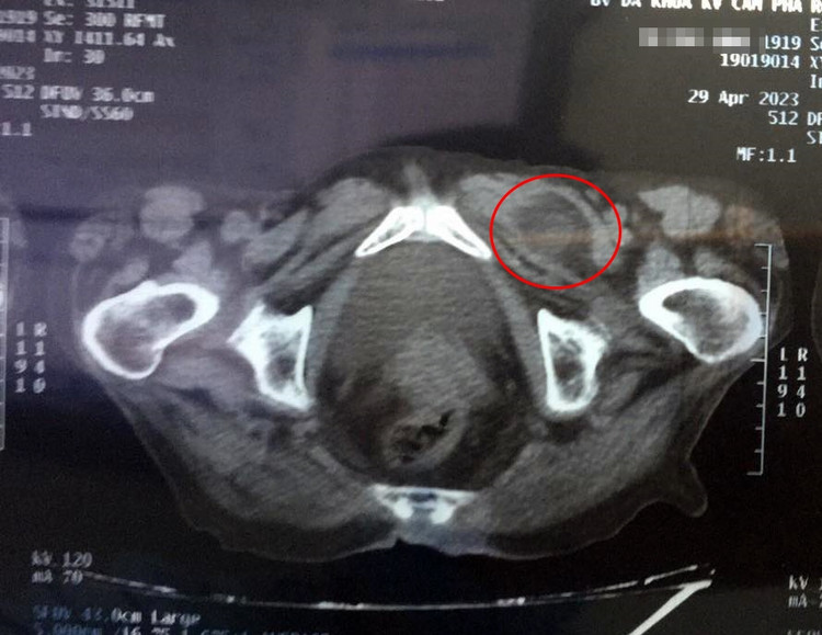 Hình ảnh khối thoát vị bịt qua phim chụp cắt lớp vi tính