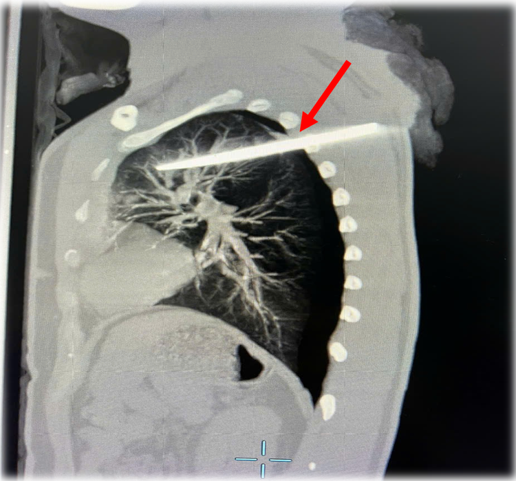 Hình ảnh chụp cắt lớp của bệnh nhân LVD ngày 29/12/2024 tại Bệnh viện TWQĐ 108 với dị vật kim khí xuyên thấu ngực (mũi tên màu đỏ) - Ảnh BVCC