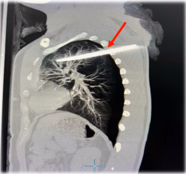 Hình ảnh chụp cắt lớp của bệnh nhân LVD ngày 29/12/2024 tại Bệnh viện TWQĐ 108 với dị vật kim khí xuyên thấu ngực (mũi tên màu đỏ) - Ảnh BVCC