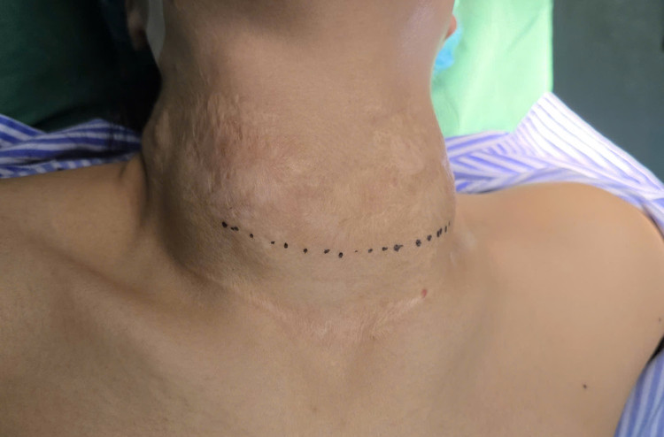 Cổ chằng chịt sẹo... vì đắp lá, uống thuốc nam - Ảnh BVCC