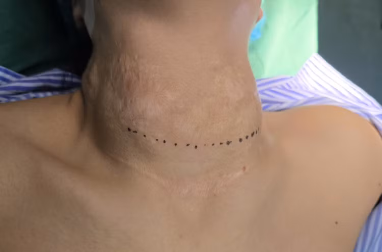 Cổ chằng chịt sẹo... vì đắp lá, uống thuốc nam - Ảnh BVCC