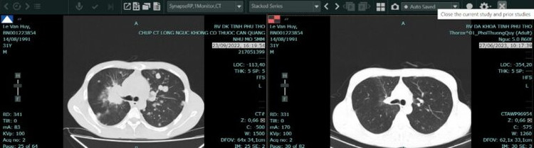 Hình chụp cắt lớp vi tính phổi của bệnh nhân ung thư phổi trước và sau điều trị