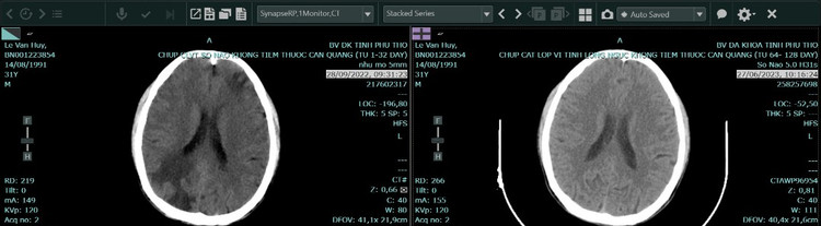 Hình chụp cắt lớp vi tính sọ não của bệnh nhân ung thư phổi trước và sau điều trị