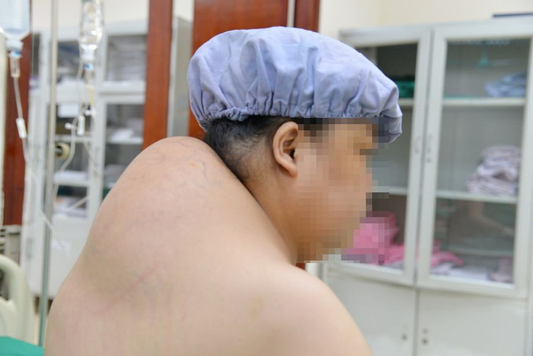 Hình ảnh u mỡ trong quá trình chuẩn bị tiến hành phẫu thuật