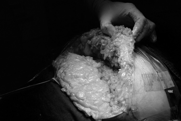 Khối u mỡ khổng lồ được cắt bỏ