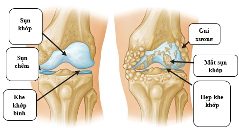 Cấu tạo của khớp gối và biểu hiện của bệnh - Ảnh BVCC