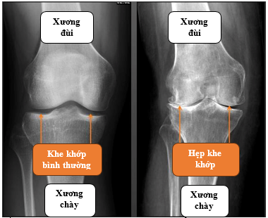 Biểu hiện của bệnh trên phim chụp - Ảnh BVCC