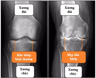 Biểu hiện của bệnh trên phim chụp - Ảnh BVCC