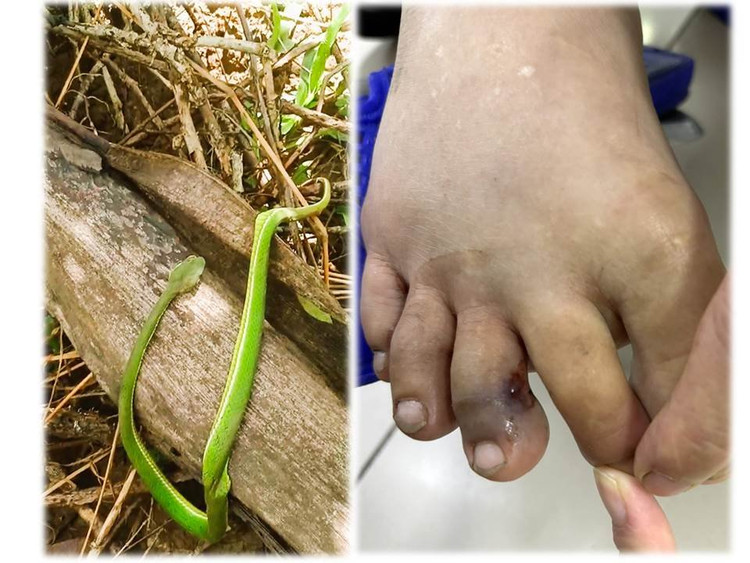 Hình ảnh rắn lục đuôi đỏ tấn công nạn nhân - Ảnh BVCC