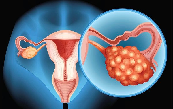 Ung thư buồng trứng - Ảnh minh họa