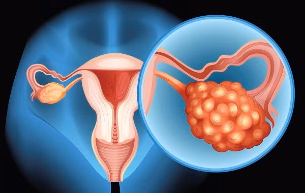 U buồng trứng - Ảnh minh họa