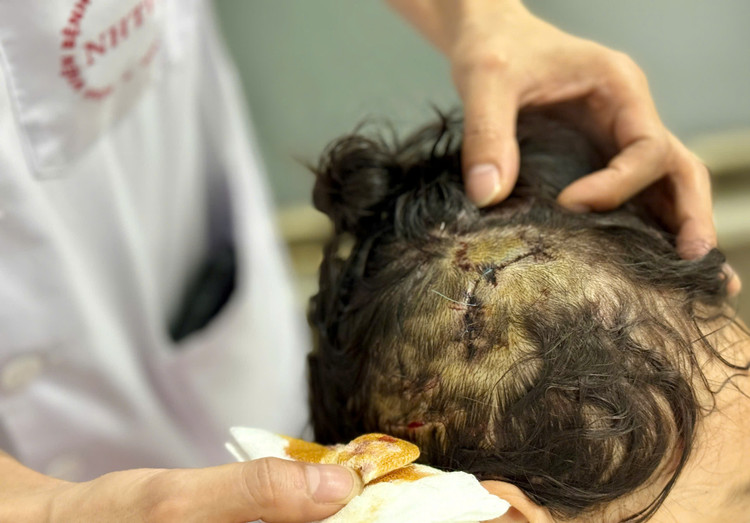 Bé gái 5 tuổi bị chó lớn tấn công vào đầu - Ảnh BVCC