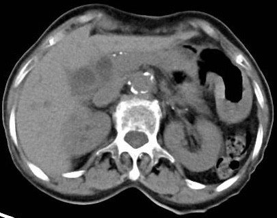 Bắt 3 con sán lá gan nhỏ trong ống mật chủ bệnh nhân 57 tuổi ảnh 1