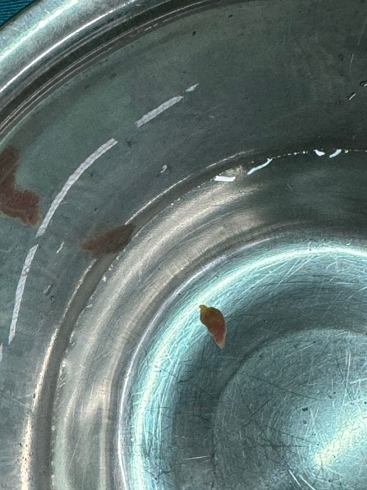 Hình ảnh 3 con sán lá gan được lấy ra - Ảnh BVCC