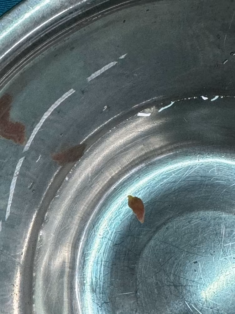 Hình ảnh 3 con sán lá gan được lấy ra - Ảnh BVCC