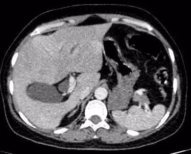 Bắt 3 con sán lá gan nhỏ trong ống mật chủ bệnh nhân 57 tuổi ảnh 2