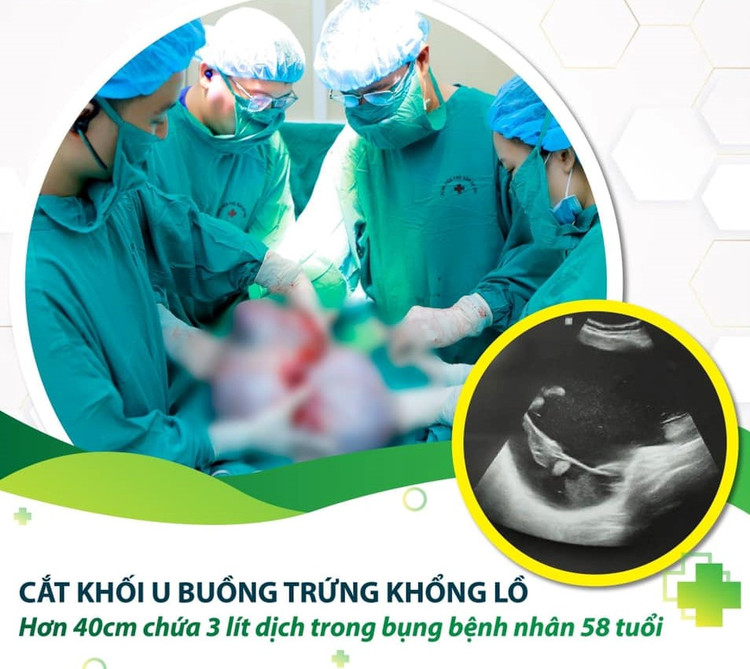 Đã cắt bán phần tử cung 30 năm vẫn bị u buồng trứng khổng lồ ảnh 1