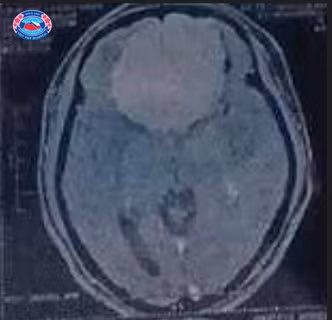 Định vị thần kinh, lấy trọn khối u màng não nền sọ kích thước khổng lồ ảnh 2
