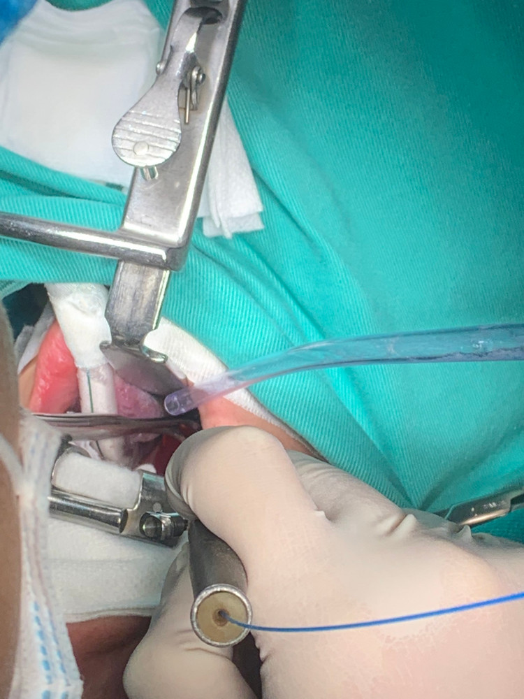 Cắt Amidan bằng Laser - Công nghệ mới nhẹ nhàng, êm ái, phục hồi nhanh chóng