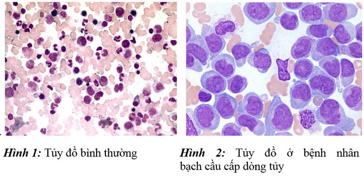 Biểu hiện tủy đồ của bệnh máu trắng - Ảnh BSCC