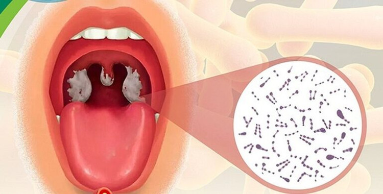 Bệnh bạch hầu họng dễ nhầm với các bệnh lý viêm họng - Ảnh minh họa BSCC