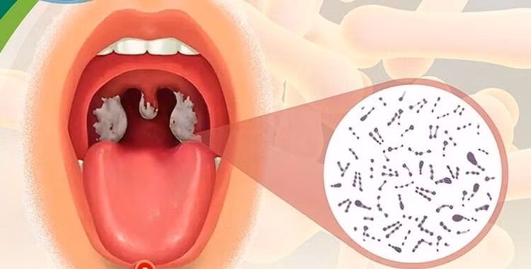 Bệnh bạch hầu họng dễ nhầm với các bệnh lý viêm họng - Ảnh minh họa BSCC