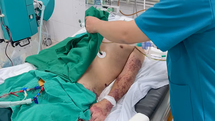 Nhiễm khuẩn huyết nguy kịch vì mắc liên cầu khuẩn khi chế biến thủ lợn - Ảnh BVCC