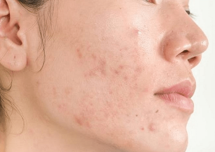 Sạm da, nổi mụn vì dùng Retinoids sai cách ảnh 1