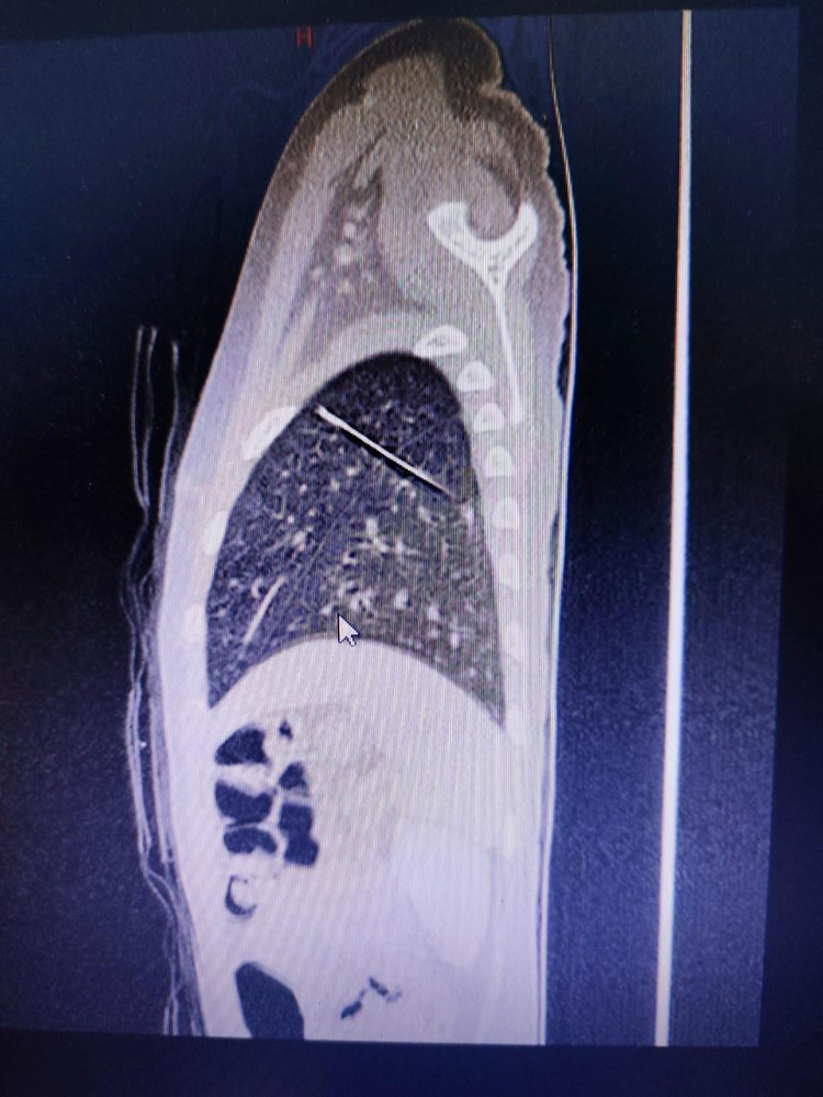 Ảnh chụp cho thấy rõ vị trí chiếc kim may áo quần trong phổi của bé